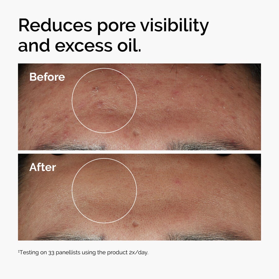 niacinamide-10-zinc-1-p5 ord-niacinamide-zinc-blemish-serum-before-after-pores.jpg